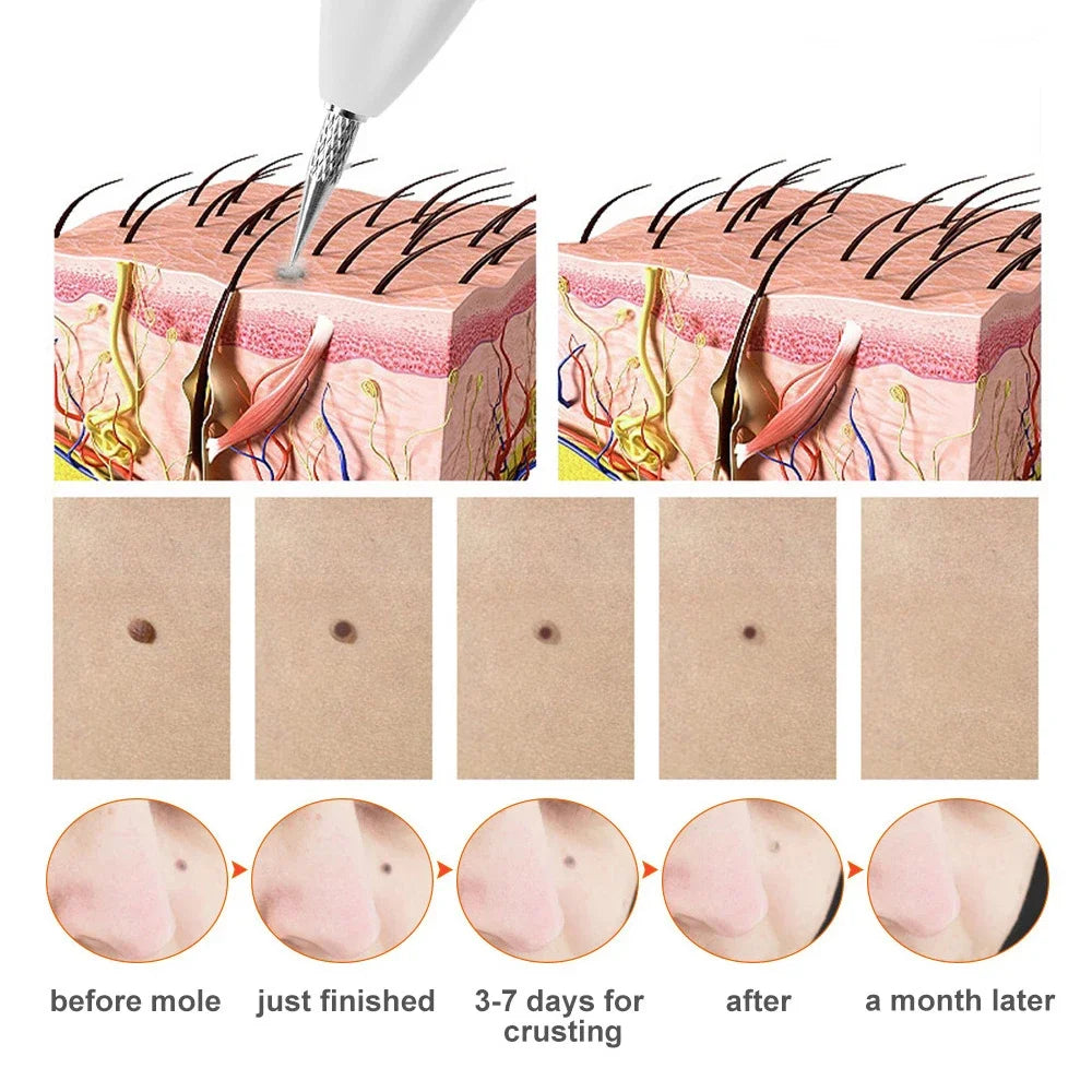 Laser Plasma Pen Replace Needles Tip for Skin Tag Dark Spot Remover Wart Mole Tattoo Removal Machine Face Beauty Care Tool Parts